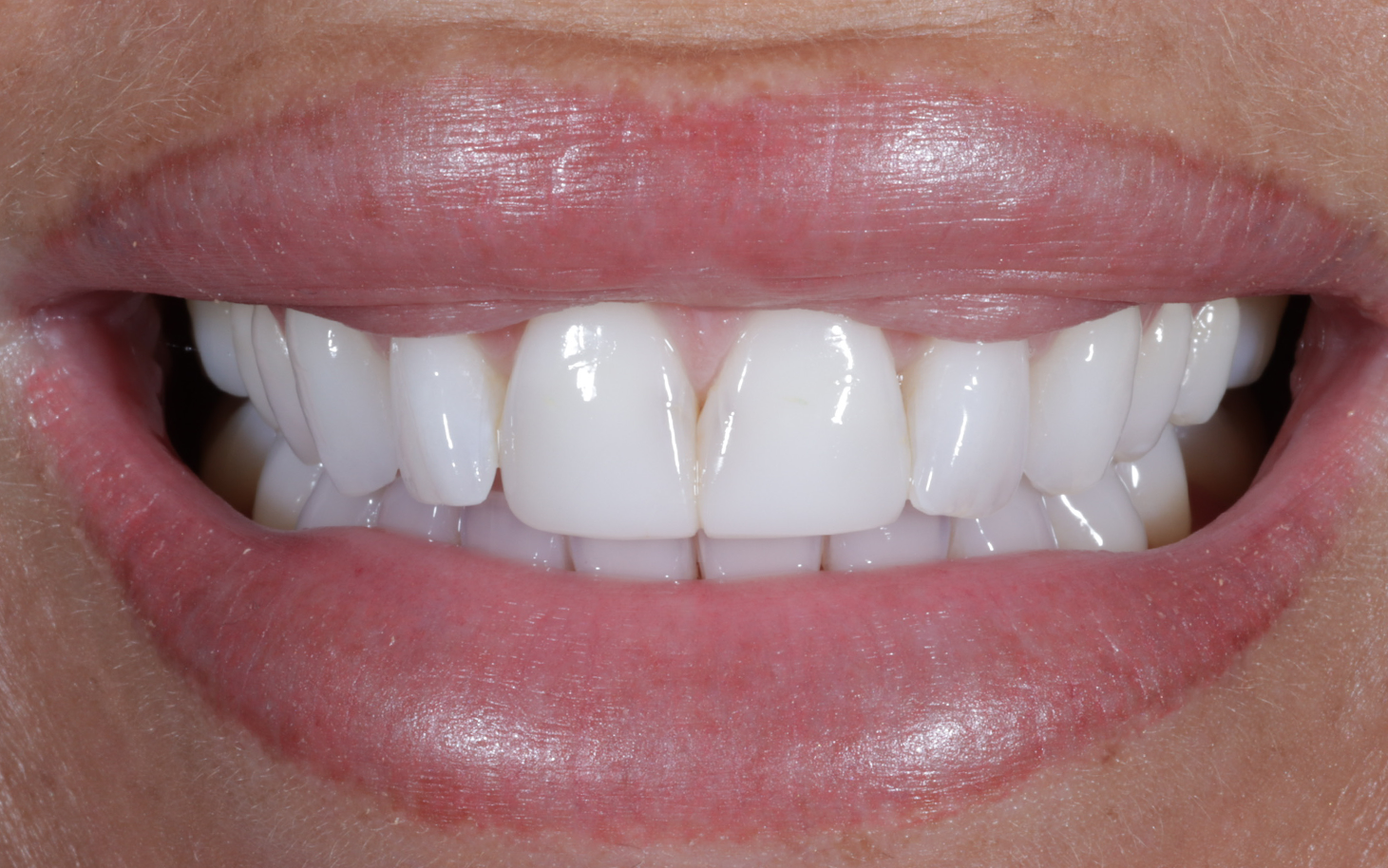 Composite Bonding. Montagu Dental