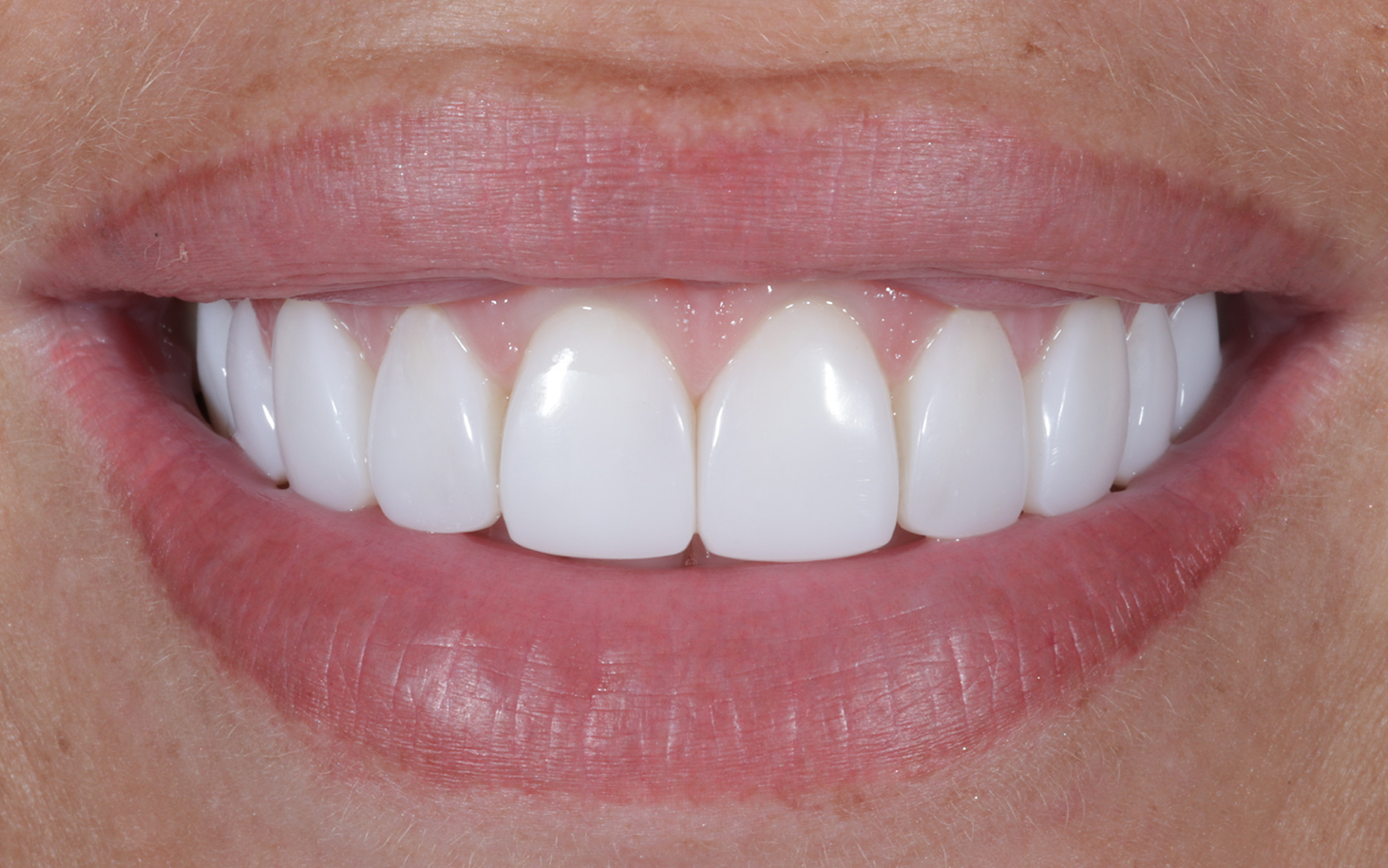 Composite Bonding. Montagu Dental