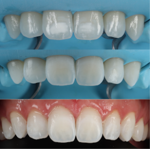 Icon Resin Infiltration Transformation for White Spots on Teeth