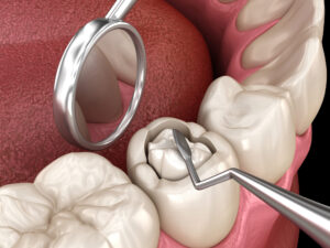 cavity
