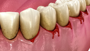 bleeding-gums-or-periodontal-pathological-inflam-2025-08-29-1bleeding-1-31-04-utc.00_00_09_00.Still001
